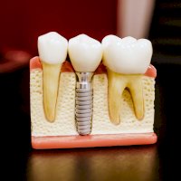 Model zubního implantátu – Photo by Jonathan Borba on Unsplash